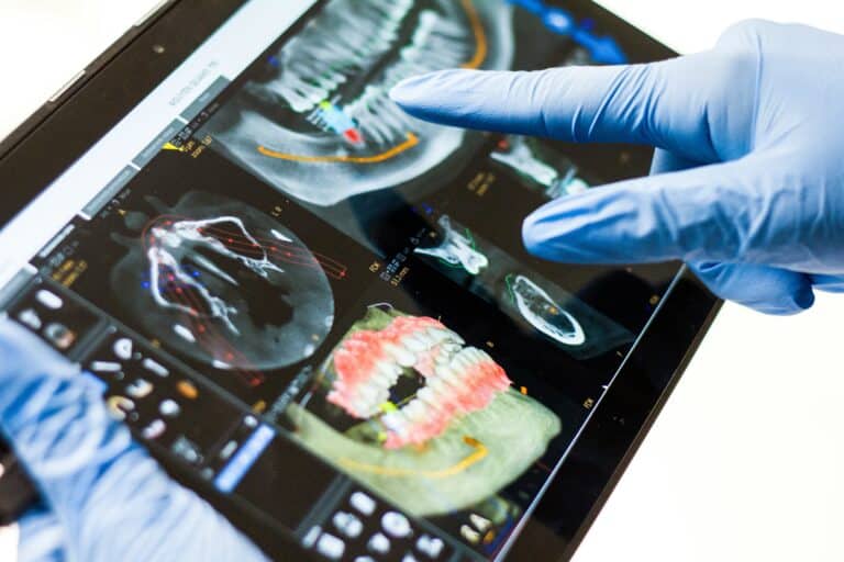 Rehabilitace 3D tiskem a okamžité zatížení u edentulozních pacientů